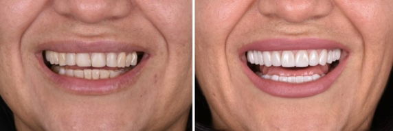 crowns-and-veneers